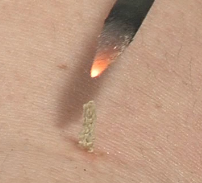 Moxibustion au grain de riz